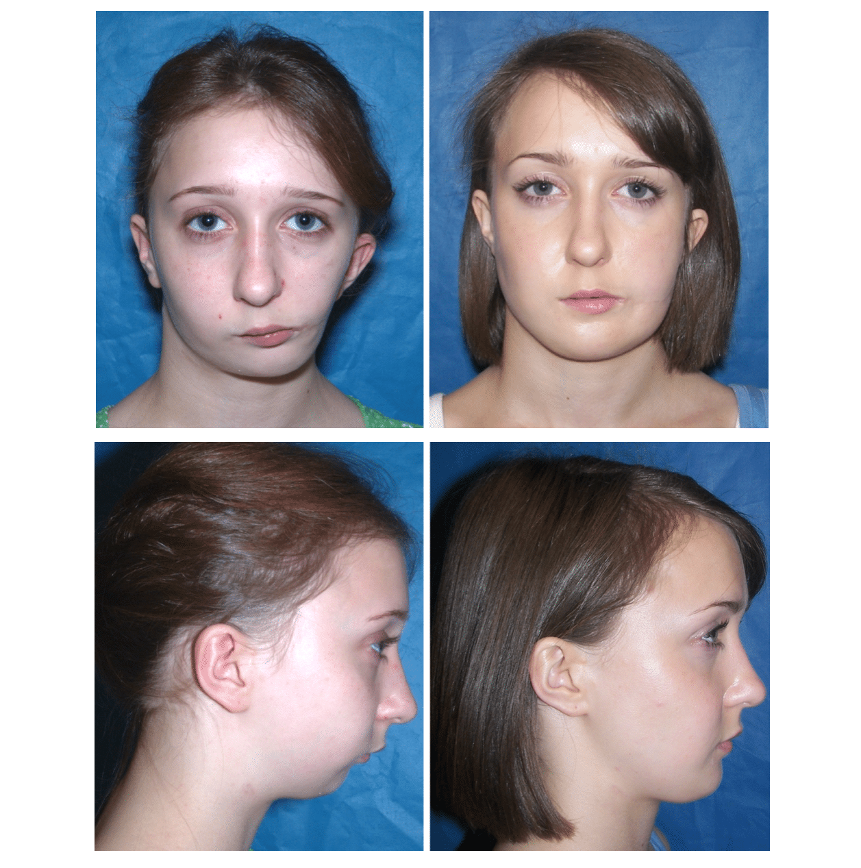 Clifton Va Maxillofacial Re Surgery And Revisions Clifton Va Maxillofacial Re Surgery And Revisions