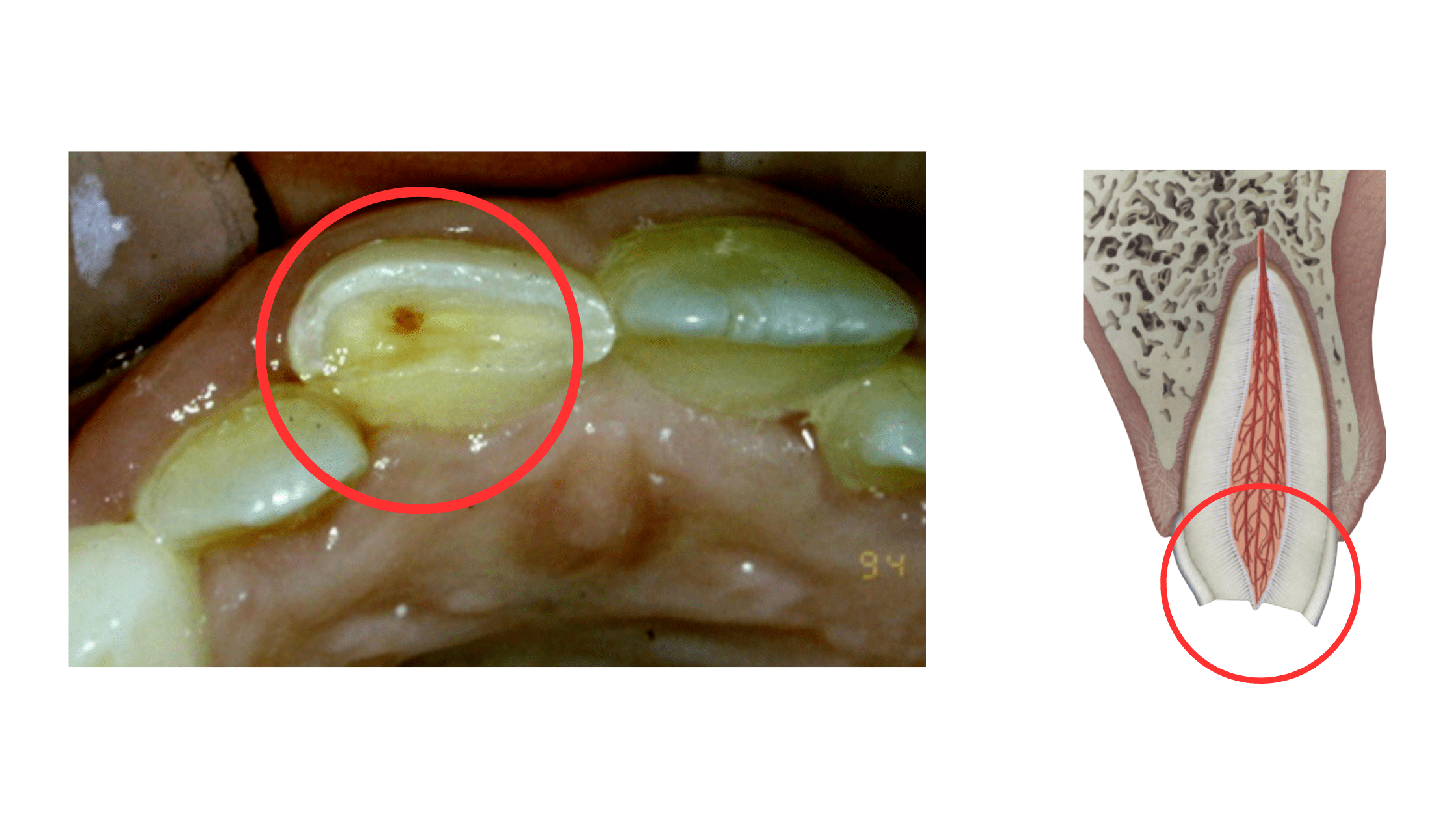 Quick Relief for Exposed Nerve in Tooth Pain
