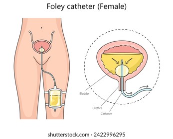 Foley Catheter for Women: Essential Guide & Tips