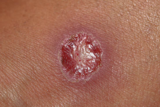 Staph Infection Symptoms Diagnosis Treatment And More Staph Infection Symptoms Diagnosis Treatment And More