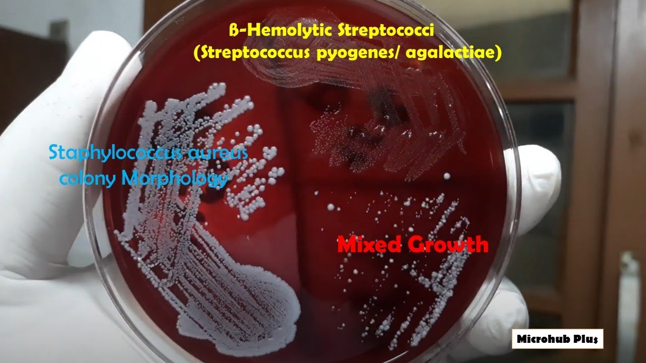 Staphylococcus Aureus Hemolysis On Blood Agar Hot Sex Picture Staphylococcus Aureus Hemolysis On Blood Agar Hot Sex Picture